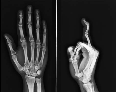 What Is Swan Neck Deformity Caused By Cheap Sale | www.opci.com