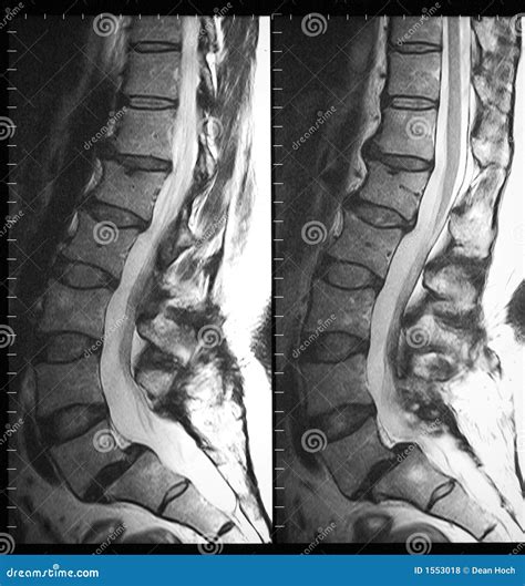Lumbar Spine Mri Labeled