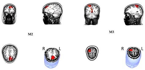Neural Correlates of Cognitive Disengagement Syndrome Symptoms in ...