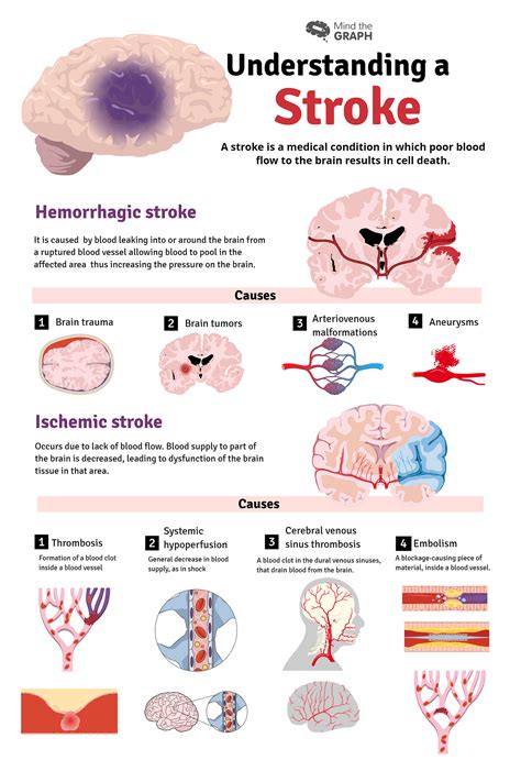 Signs Of Stroke In Men: What You Need To Know – BLGQMG
