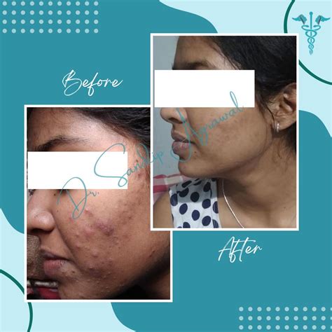 Treatment Gallery - Dr. Sandip Agrawal
