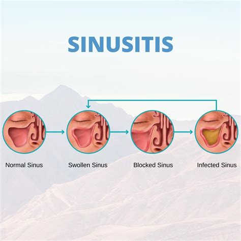 👃 Sinusitis is an inflammation of the tissues lining the sinuses. When ...