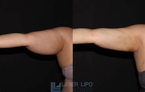Lipedema - Arms - Laser Lipo & Vein Center