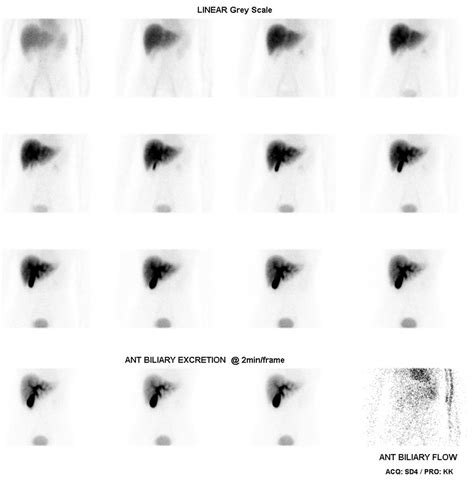 HIDA Scan Procedure - Scan Results, Scan Side Effects