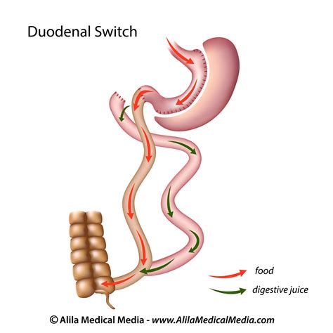 Duodenal Switch - Frisco, TX: The Bariatric Experts™: Bariatric and Minimally Invasive Surgery