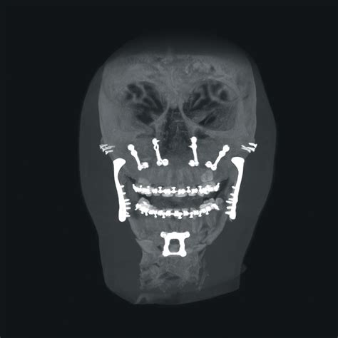 Oral and Maxillofacial surgery - Ziehm Imaging | EN