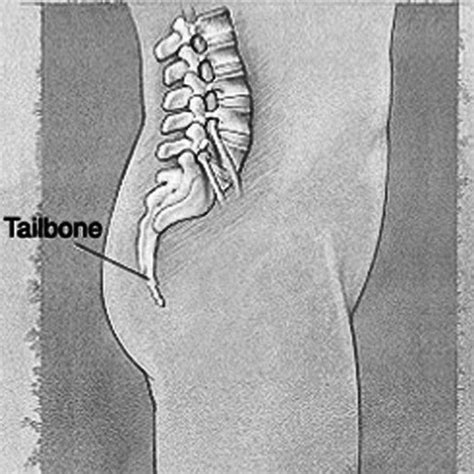 Bruised tailbone - Symptoms, Causes, Treatment, Healing time - HubPages