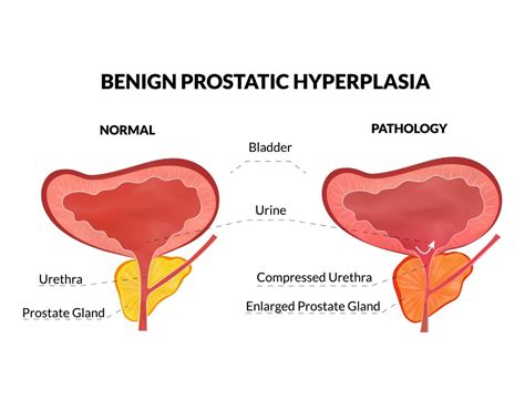 Early Signs of Benign Prostatic Enlargement - Enlarged Prostate Symptoms and Treatments