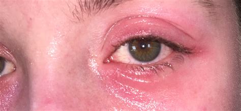 Bildergebnis für augenlidentzündung bilder