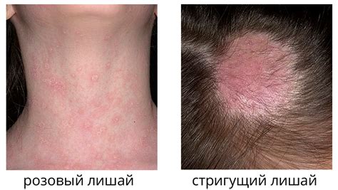 Как выглядит лишай у человека на начальной стадии (Фото)