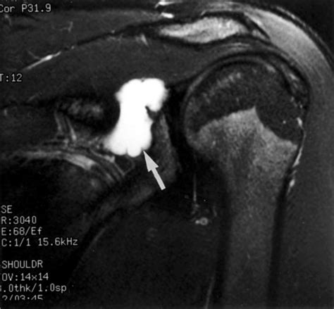 Rhoda's CT/MRI Procedures II: Ganglion Cyst of the Shoulder