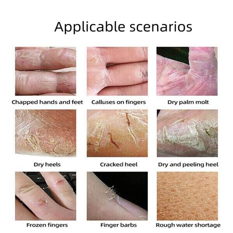 Buy Foot Cream Hand and Foot Repair Cream Cracked Skin Repair Cream ...