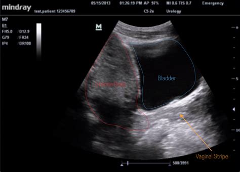 Ultrasound Leadership Academy: The Basics of Pelvic Transabdominal ...