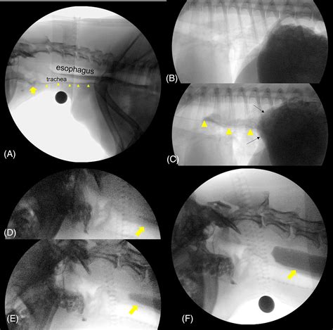 Videofluoroscopic swallow study abnormalities identify aerodigestive ...