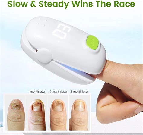 At Home Laser Treatment For Toenail Fungus