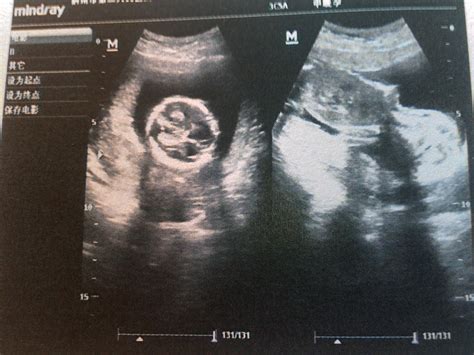 怀孕4个月3d胎儿超高清图片下载-正版图片504360399-摄图网