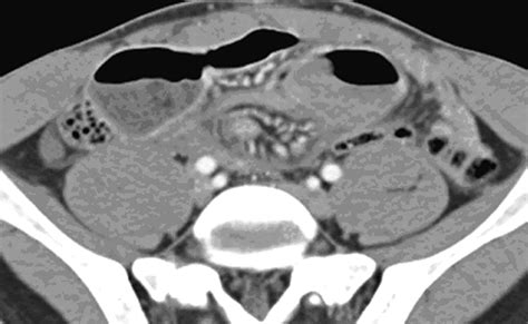 Imaging Manifestations of Meckel's Diverticulum | AJR