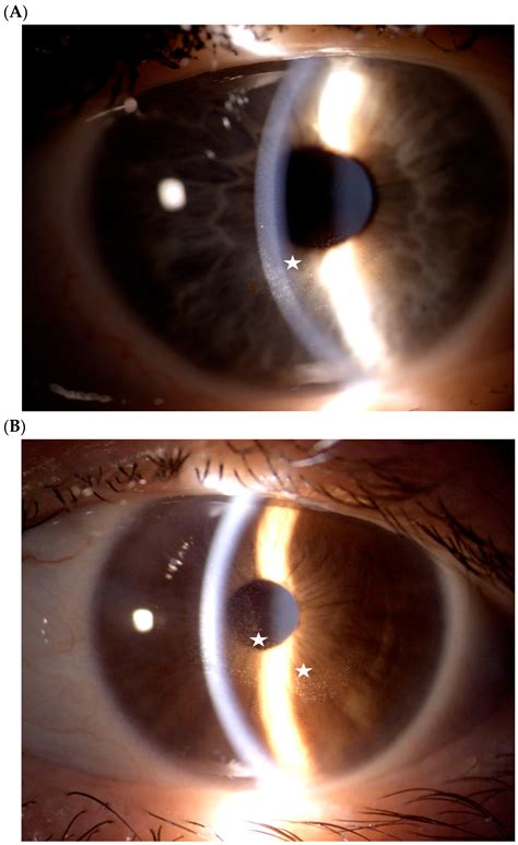 Corneal Toxicity of Mirvetuximab Soravtansine: Multimodal Imaging ...