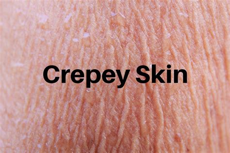 What Is Crepey Skin