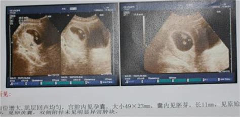 怀孕7周双胞胎b超图片_第二人生
