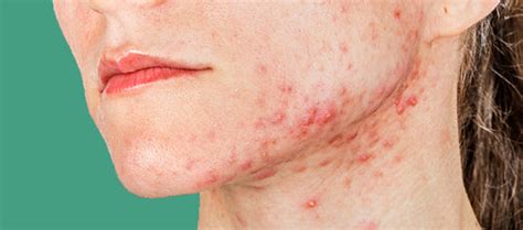 Get Acne-Clear Skin In 7 Weeks Even If You Do Not Follow A Basic Skinc ...