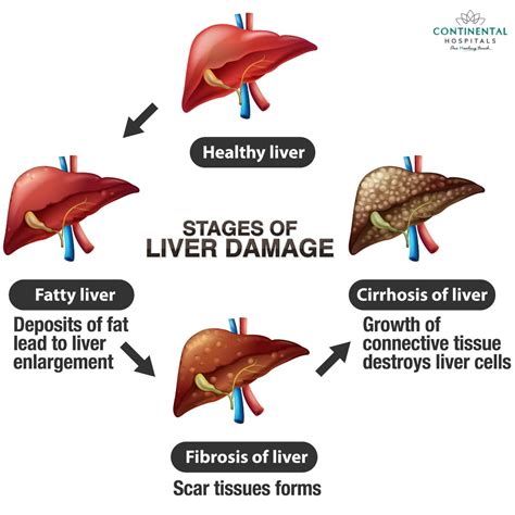 Common Symptoms of Liver Diseases You Shouldn't Ignore