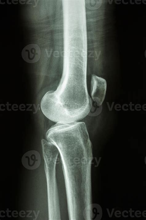 Lateral Knee Joint X Ray , Pediatric knee radiograph (an approach) – YDYMO