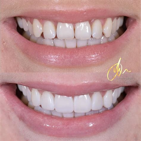 Composite Bonding – Dr Andrew Culbard