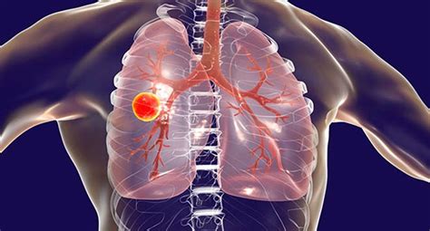 Stigma, Myths and Misconceptions related to TB | SAKSHAM LMIS - NIHFW
