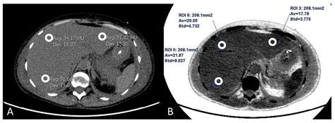 Assessment of Liver Fat: Dual-Energy CT versus Conventional CT with and ...