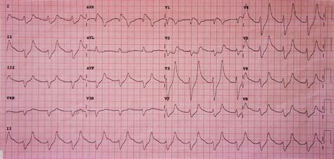 Hyperkalaemia | ECG Changes | Calcium | Geeky Medics
