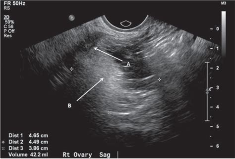 Dermoid Cyst Ovary