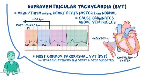 Arrhythmias - Supraventricular tachycardia (SVT): Nursing: Video ...