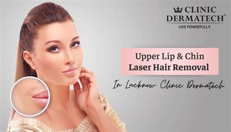 Laser Hair Removal Results Upper Lip