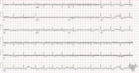 Digoxin Toxicity | ECG Stampede