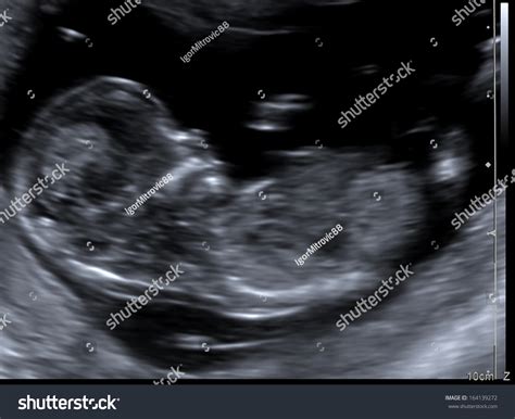 12 Week Ultrasound Down Syndrome
