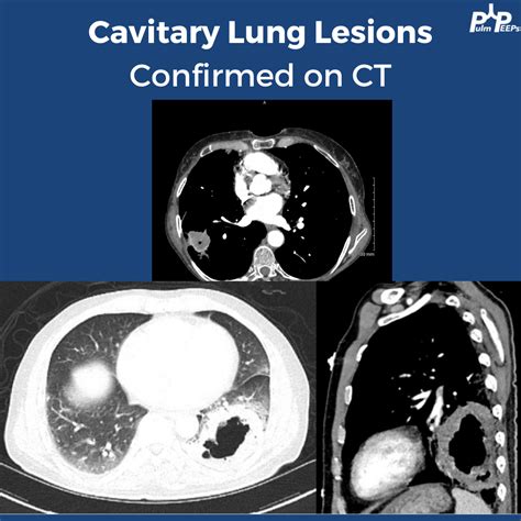 PulmPEEPs | Pulmonary and Critical Care content for learners and practitioners of all levels