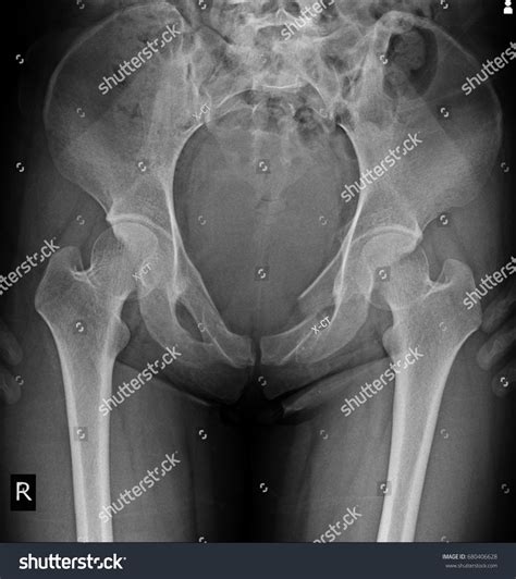 Pelvic Inlet View Bony Pelvis | Bones, Ligaments, Vasculature | Geeky