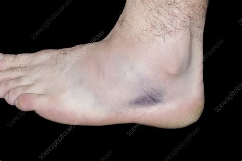 Sprained ankle - Stock Image - C014/7972 - Science Photo Library