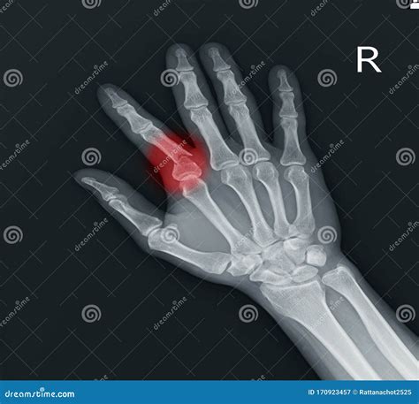 Fracture Index Proximal Phalanx Showing X-ray Hand. Stock Image - Image ...