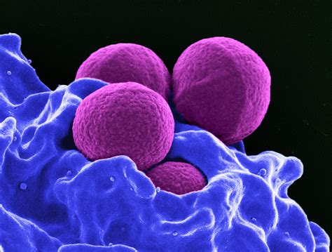 Newly discovered antibiotic in nose viewed as preventive against MRSA