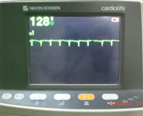 Icd 10 code for atrial flutter - kopolresume
