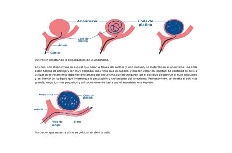 Aneurisma Cerebral: Síntomas, Identificación y Tratamiento
