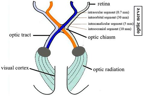 Predictors in Optic Pathway Gliomas in Neurofibromatosis Type 1: A Single Center Study