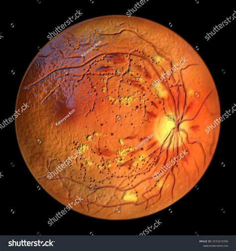 Nonproliferative Diabetic Retinopathy 3d Illustration Showing Stock ...
