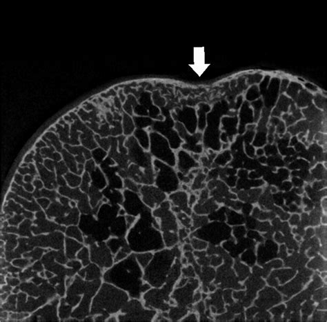 How much force is acting on the shoulder joint to create a Hill-Sachs Lesion or reverse Hill ...
