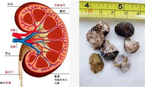 肾结晶与肾结石的防治 - 知乎