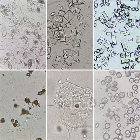 Urine microscopy and casts image atlas key squamous – Artofit