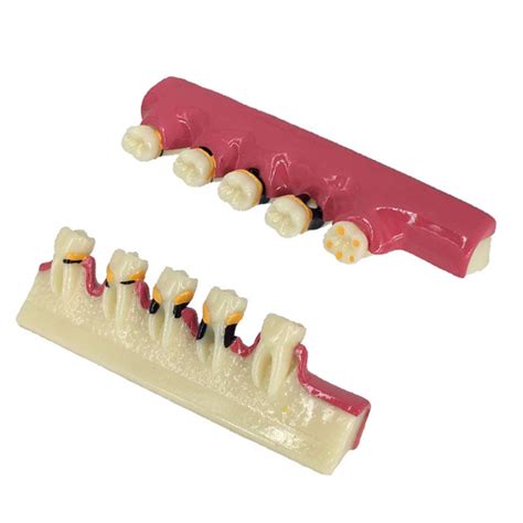 Xieji Periodontitis Periodontal Disease Classification Model Dental ...