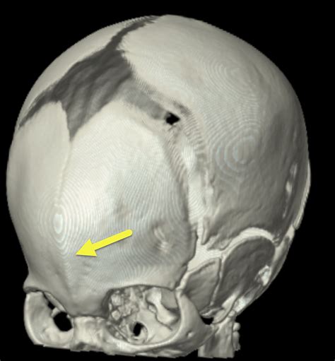 Metopic Suture Synostosis | Applied Radiology